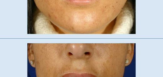 Botox for a More Natural-Looking and Symmetrical Lips